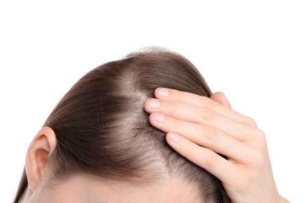 Girl with hair loss problem on white background, closeupの写真素材
