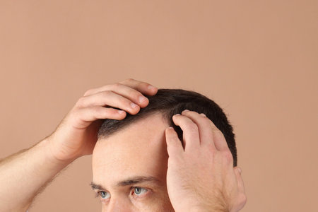 Baldness problem. Man with receding hairline on beige background, closeup