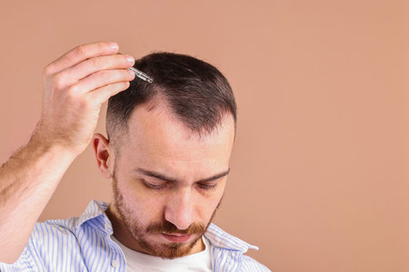 Baldness problem. Man applying serum onto hairline on dark beige background, space for text