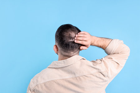Baldness problem. Man with bald spot on light blue background, back viewの写真素材