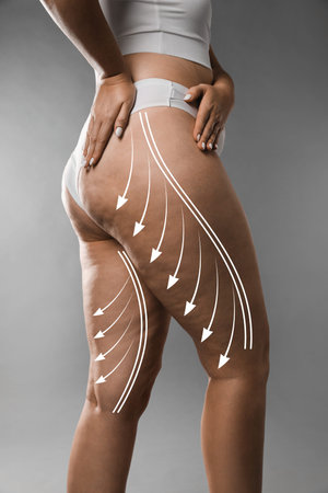 Woman with orange peel skin on hips against gray background, closeup. Weight loss and anti-cellulite...