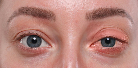Conjunctivitis. Young woman with bloodshot in eye, closeupの写真素材