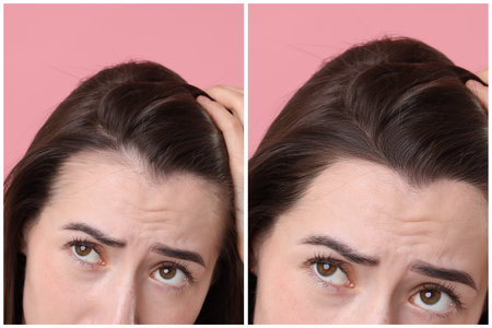 Young woman suffering from hair loss problem on pink background, closeup. Collage with photos before...