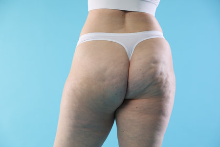 Woman with cellulite on light blue background, closeupの写真素材
