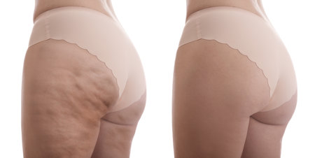 Cellulite treatment, before and after collage. Young woman showing her body on white background, closeupの写真素材