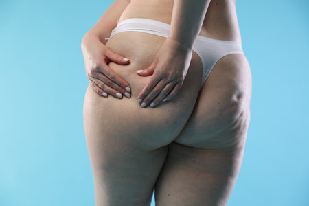 Woman with cellulite on light blue background, closeupの写真素材
