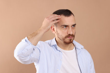 Baldness problem. Man with receding hairline on beige backgroundの写真素材