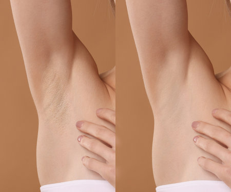 Epilation and depilation. Collage with photos of woman showing armpit after different procedures on light brown background, closeupの写真素材