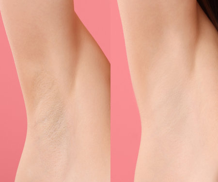 Epilation vs depilation. Collage with photos of woman showing armpit after different procedures on pink background, closeupの写真素材