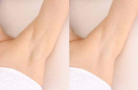 Epilation and depilation. Collage with photos of woman showing armpit after different procedures on light background, closeupの写真素材