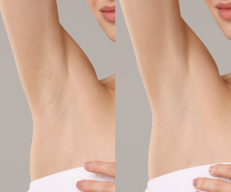 Epilation and depilation. Collage with photos of woman showing armpit after different procedures on gray background, closeupの写真素材