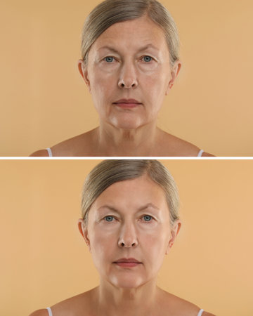 Senior woman showing face before and after collagen consumption on beige background. Collage of photos comparing skin conditionの写真素材
