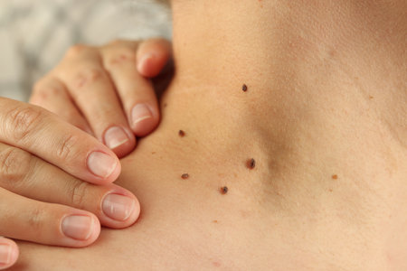 Doctor examining woman's moles on blurred background, closeupの写真素材