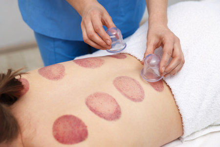 Therapist giving cupping treatment to patient in spa salon, closeupのeditorial素材