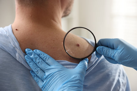 Doctor examining man's moles in hospital, closeupの写真素材