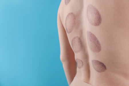 Woman after cupping therapy on light blue background, closeup. Space for text
