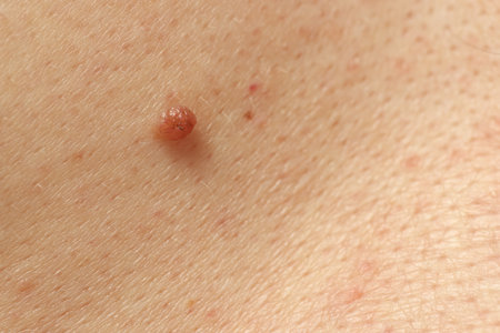 Man with mole on his skin, closeupの写真素材