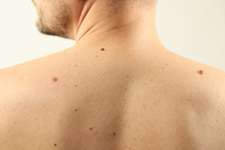 Man with moles on his skin against light background, closeup
