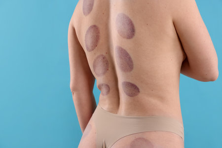Woman after cupping therapy on light blue background, closeupの写真素材