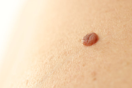 Man with mole on his skin, closeup. Space for textの写真素材
