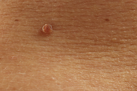 Man with mole on his skin, closeup