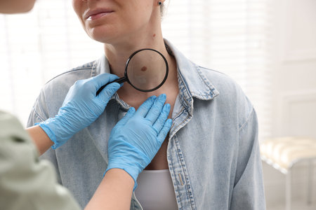 Doctor examining woman's moles in hospital, closeupのeditorial素材