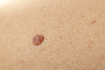 Man with mole on his skin, closeup