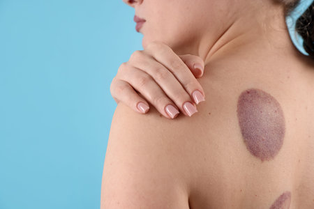 Woman after cupping therapy on light blue background, closeup. Space for text
