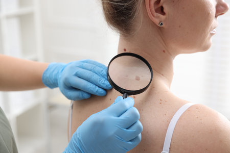 Doctor examining woman's moles in hospital, closeupのeditorial素材