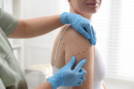 Doctor examining woman's moles in hospital, closeupの写真素材