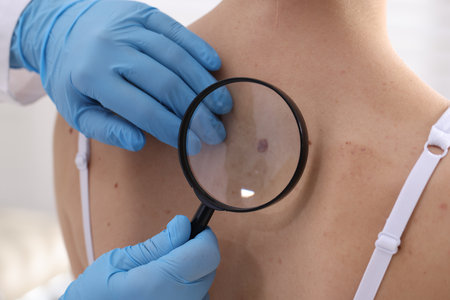 Doctor examining woman's moles in hospital, closeupのeditorial素材