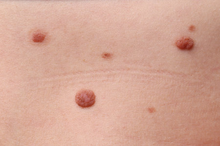 Woman with moles on her body, closeup