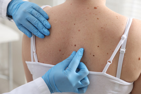 Doctor examining woman's moles in hospital, closeupのeditorial素材