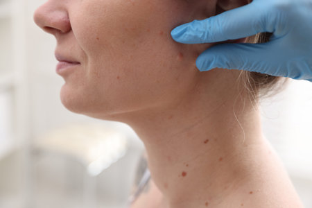 Doctor examining woman's moles in hospital, closeup
