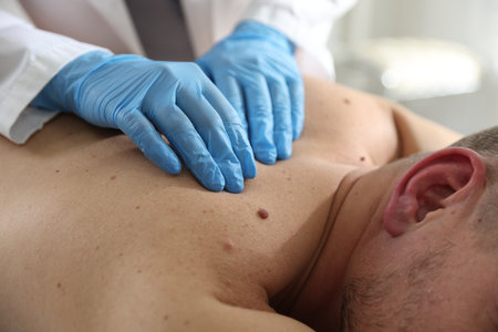 Doctor examining man's moles in hospital, closeupの写真素材