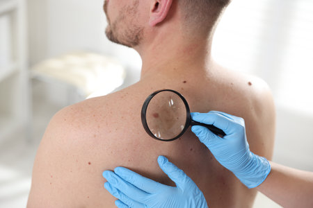 Doctor examining man's moles in hospital, closeupの写真素材