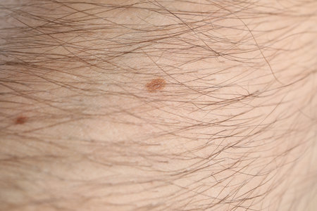 Man with moles on his body, closeupの写真素材