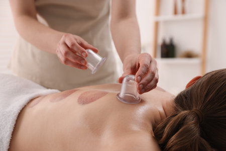 Therapist giving cupping treatment to patient in spa salon, closeupの写真素材
