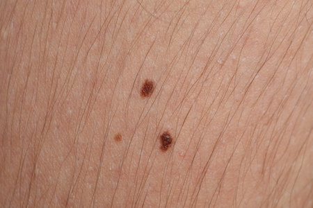 Woman with moles on her body, closeupの写真素材