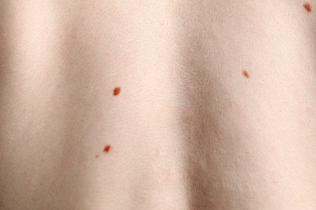 Woman with moles on her body, closeup