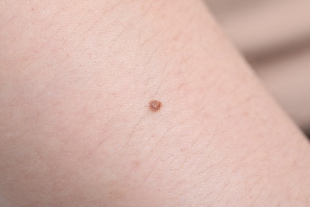 Woman with mole on her skin, macro view