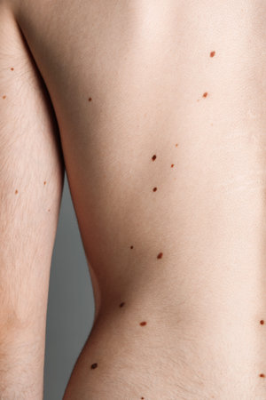 Man with moles on his body against gray background, closeup