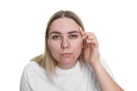 Woman with acne problem on white background