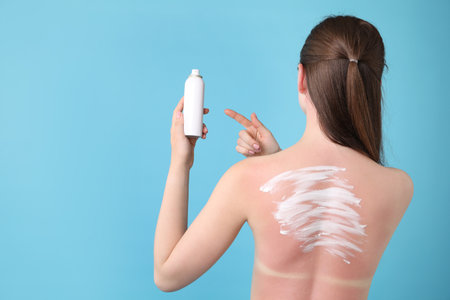 Woman with sunburned skin holding bottle of sun protection product on light blue background, back view. Space for textの写真素材