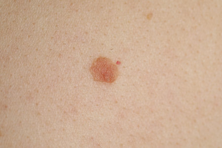 Woman with mole on her skin, macro view
