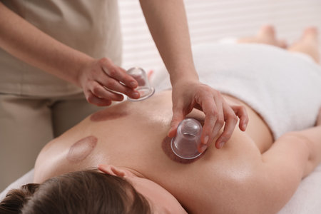 Therapist giving cupping treatment to patient in spa salon, closeupの写真素材