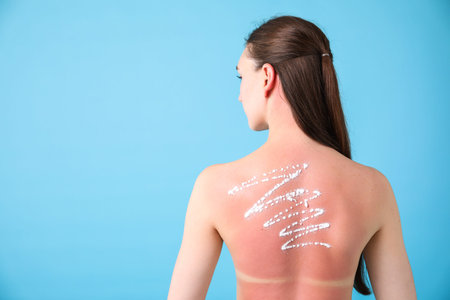 Woman with sun protection product on her sunburned skin against light blue background, back view....