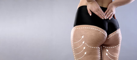 Liposuction. Woman showing her figure against gray gradient background, closeup. Markings on her...