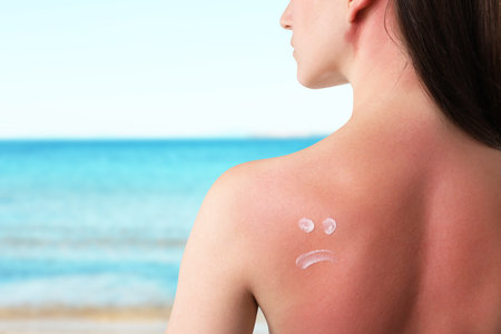 Woman with sunburned skin against sea, back view.