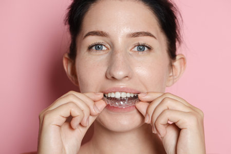 Beautiful woman wearing dental aligner on pink background, closeupの写真素材